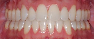 Orthodonitic, Braces After Photo